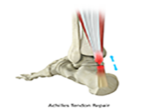 Achilles Tendon Repair