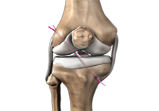 ACL Reconstruction