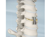 Anterior Cervical Discectomy