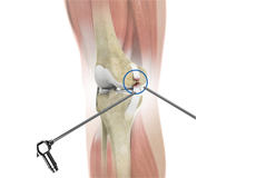 Arthroscopic Reconstruction of the Knee for Ligament Injuries