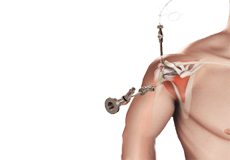 Arthroscopic Rotator Cuff Repair