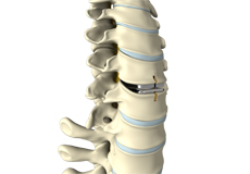 Artificial Cervical Disc Replacement