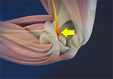 Ulnar Nerve Entrapment