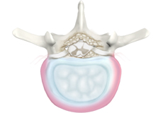 Degenerative Disc Disease