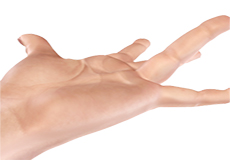 Dupuytren’s Contracture 