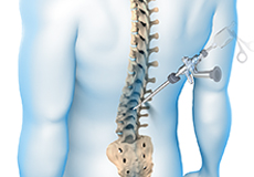 Endoscopic Spine Surgery