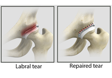 Hip Labral Repair