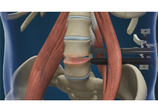 Lumbar Discectomy