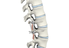 Lumbar Interbody Fusion