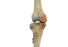 Knee Osteotomy