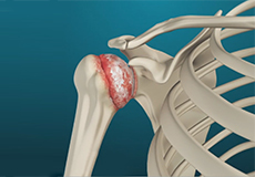 Shoulder Arthrits