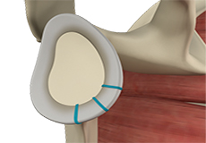 Shoulder Labrum Reconstruction