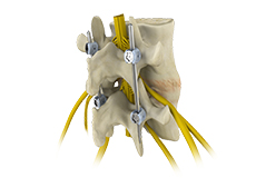 Spinal Fusion