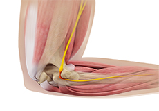 Ulnar Nerve Transposition